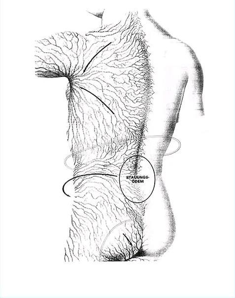 Diagram of lymphatic drainage pathways across the torso and back, highlighting congestion zones